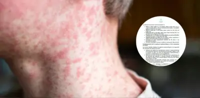 Colombia confirma tres casos importados de sarampión y refuerza vacunación ante Mundial 2026