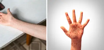 Colombia investiga 4 casos sospechosos de sarampión importados en vuelos internacionales