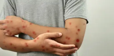 Colombia investiga caso sospechoso de sarampión en Bogotá tras viaje internacional del paciente