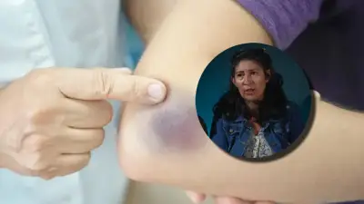 Madre alerta sobre desconocimiento de hemofilia en sistema de salud colombiano