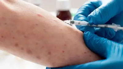 MinSalud aclara: caso sospechoso de sarampión en Bogotá sigue en estudio, sin confirmación