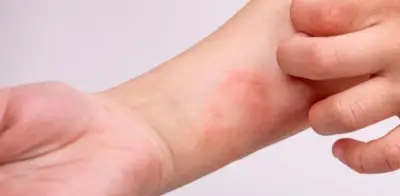 Minsalud refuerza prevención tras confirmar tres casos de sarampión en Colombia