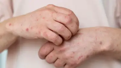 Sarampión en Colombia: Minsalud activa protocolos ante casos sospechosos y alerta sobre síntomas