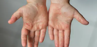 Viruela del mono se expande en Santander: casos confirmados en Piedecuesta y Barrancabermeja