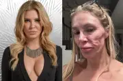 Brandi Glanville revela que implantes mamarios rotos causaron infección y desfiguración facial