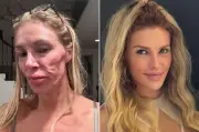Brandi Glanville revela que implantes mamarios rotos causaron su desfiguración facial