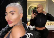 Muerte de influencer británico Jordan James Parke reabre debate sobre riesgos de cirugías estéticas extremas