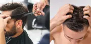 Tiña capitis: el 'hongo de las barberías' que se propaga en cortes de cabello