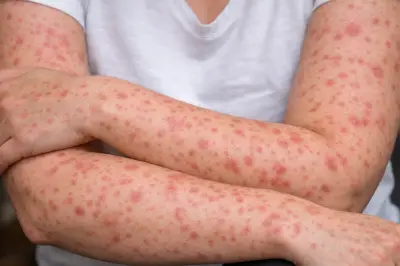 Barrancabermeja activa protocolos preventivos tras primer caso de sarampión en Santander