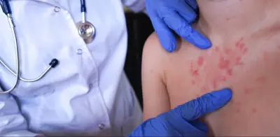 Bogotá ofrece su laboratorio para acelerar diagnóstico de sarampión tras casos importados