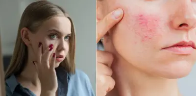 Dermatólogos alertan sobre el infradiagnóstico de la rosácea y sus riesgos sin tratamiento