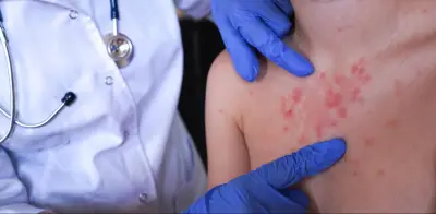 Valle del Cauca en alerta por sarampión: Secretaría de Salud urge vacunación ante casos importados