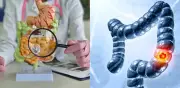 Cáncer de colon en jóvenes: aumenta 2% anual en menores de 50 años según especialistas
