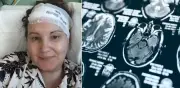Mujer galesa convivió 20 años con tumor cerebral del tamaño de una mandarina sin diagnóstico