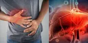Síntomas tempranos de la cirrosis hepática: señales que no deben ignorarse