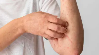 Colombia confirma primer caso de viruela símica clado Ib en Antioquia