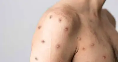 Detectan en Antioquia el primer caso de variante de viruela símica en Colombia