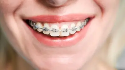 Invima alerta sobre riesgos de comprar dispositivos de ortodoncia en redes sociales