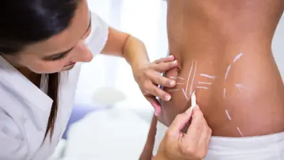 La liposucción no es la única opción: expertos explican cirugías para abdomen