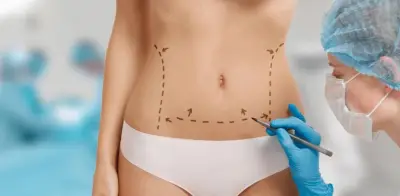 Liposucción lidera cirugías estéticas en Colombia con más de 41.000 procedimientos anuales