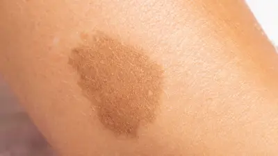 Manchas cafés en niños: síntoma clave de la neurofibromatosis tipo 1