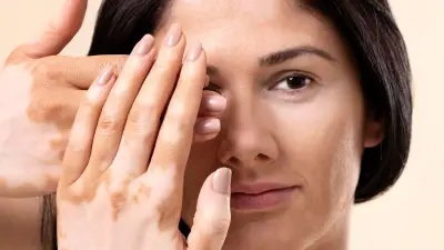 Vitiligo: la enfermedad de la piel que padecía Michael Jackson