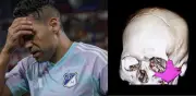 Fractura de arco cigomático: la grave lesión facial que sufrió Falcao García en partido de Liga BetPlay