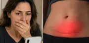 Mujer descubre tijeras olvidadas en su abdomen tras abdominoplastia en Italia