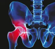 Osteoporosis en Colombia: una epidemia silenciosa de fracturas