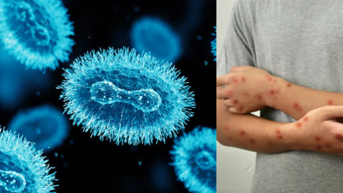 Confirman segundo caso de mpox clado Ib en Bogotá, sin transmisión comunitaria